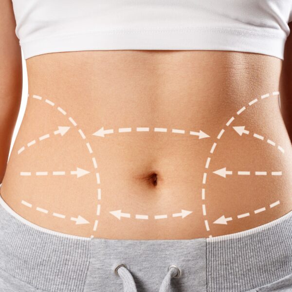 Les body lifts ou lifting circulaires — Clinique Esthétique Ferrère, Bordeaux