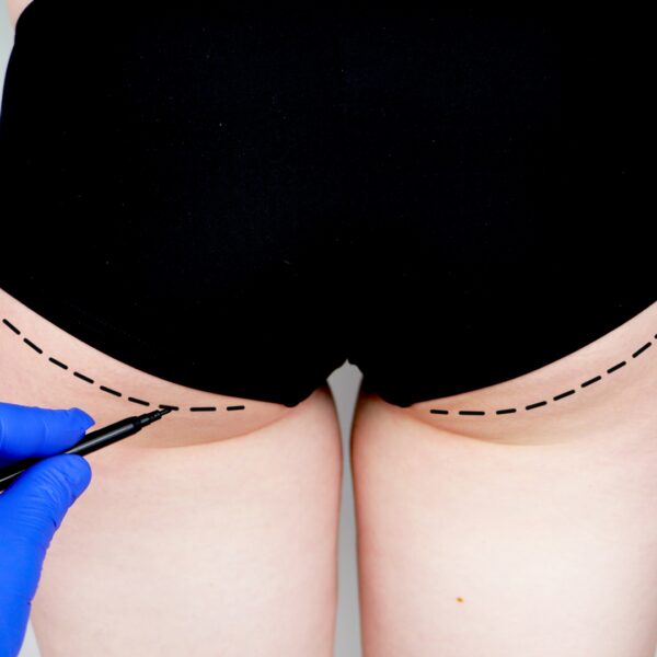 Les body lifts ou lifting circulaires — Clinique Esthétique Ferrère, Bordeaux