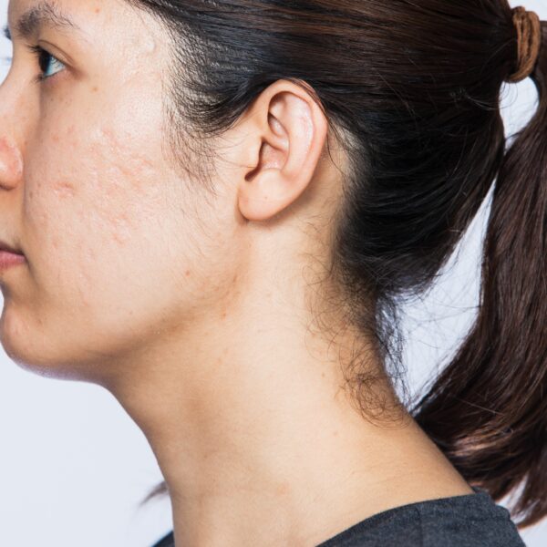 Chirurgie des tumeurs cutanées et des cicatrices inesthétiques — Clinique Esthétique Ferrère, Bordeaux