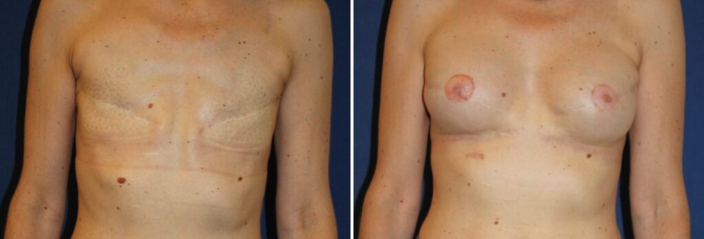 Reconstruction mammaire différée bilatérale, implants A2X-295, lipomodelage 250 cc par sein, plaque aréolo-mamelonnaire — avant et après, Dr Armand Azencot, Bordeaux