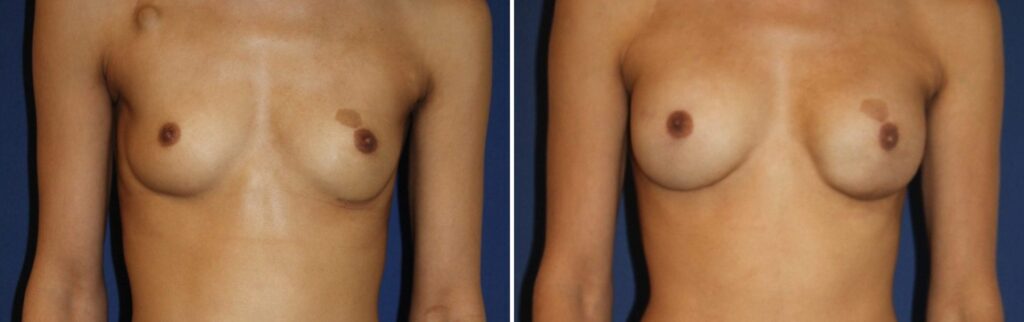 Reconstruction bilatérale, curative à gauche et prophylactique à droite, implants ERSD-320, lipomodelage bilatéral 200 cc par sein — avant et après, Dr Armand Azencot, Bordeaux