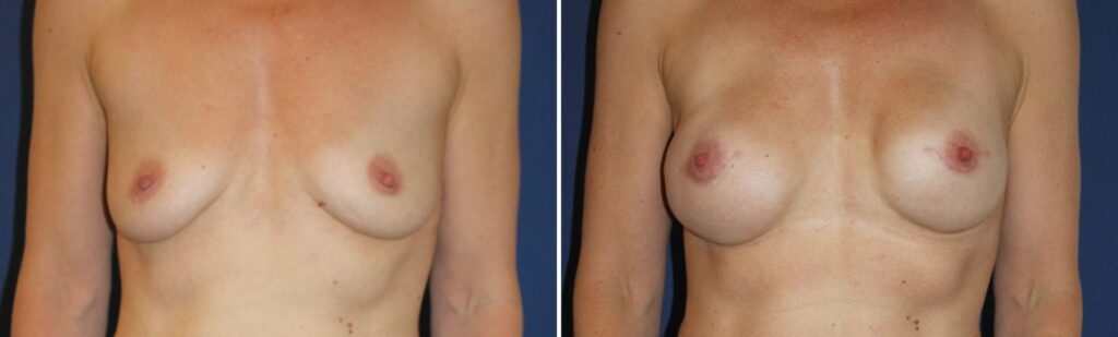 Mammectomie bilatérale prophylactique, reconstruction immédiate, implants ERSD-360 cc — avant et après, Dr Armand Azencot, Bordeaux