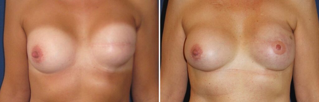 Réfection de reconstruction mammaire gauche et plastie d’augmentation du sein droit, remplacement d’implants A2X-295 et AN-165, lipomodelage — avant et après, Dr Armand Azencot, Bordeaux